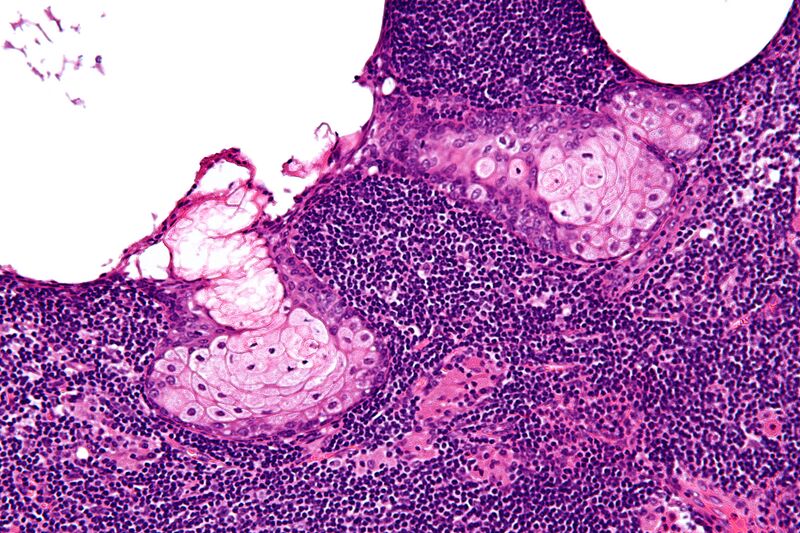 File:Sebaceous lymphadenoma - high mag.jpg