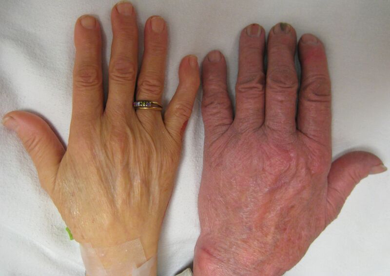 File:Anemia.JPG