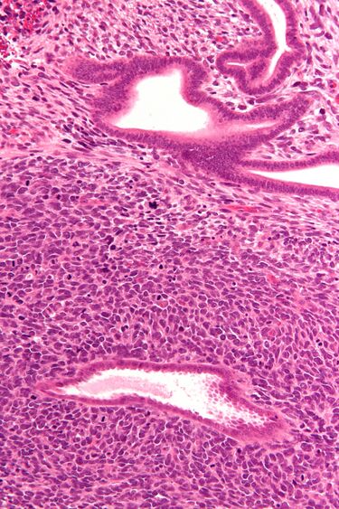 File:Uterine adenosarcoma - high mag.jpg