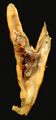 Carotid artery plaque