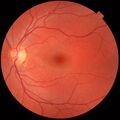 Normal fundus photograph of the left eye, showing macula and optic disc