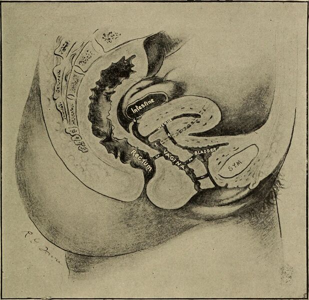 File:Gynecological diagnosis (1910) (14591554198).jpg