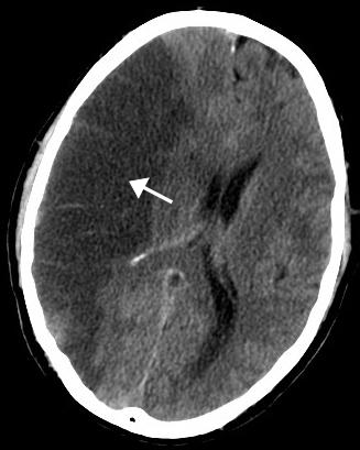 File:MCA Territory Infarct.svg