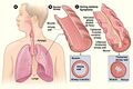 Asthma attack illustration