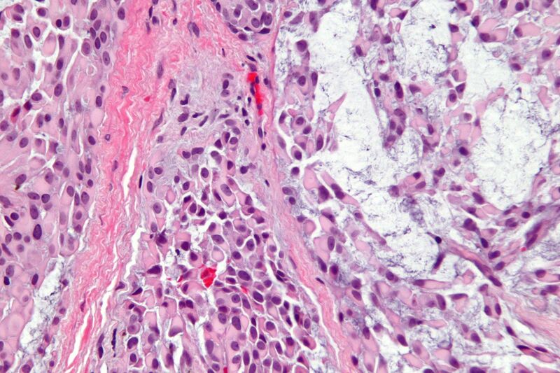 File:Myoepithelioma - very high mag.jpg