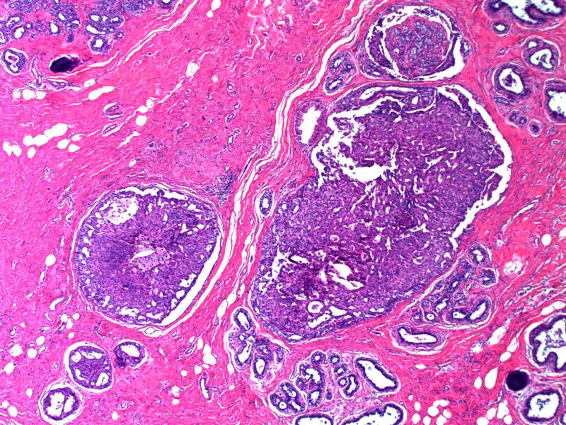 File:Breast IntraductalPapillomatosis LP CTR.jpg