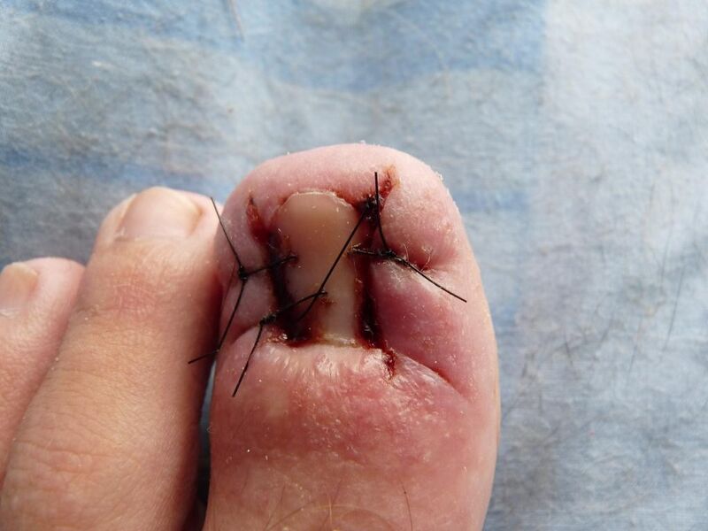 File:Ingrownnail postop.jpg