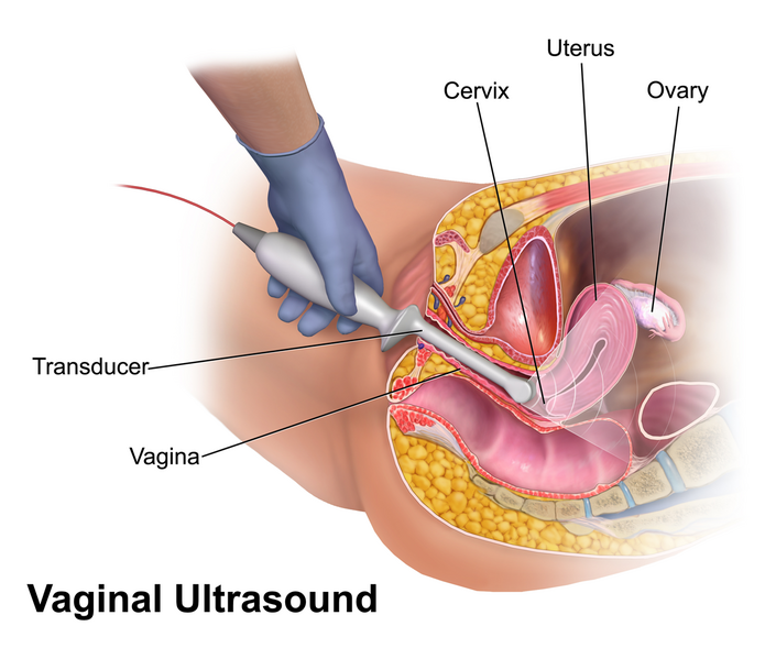 File:Vaginal Ultrasound.png