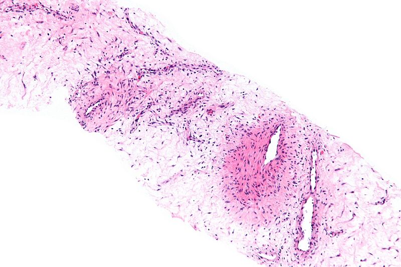 File:Aggressive angiomyxoma - intermed mag.jpg