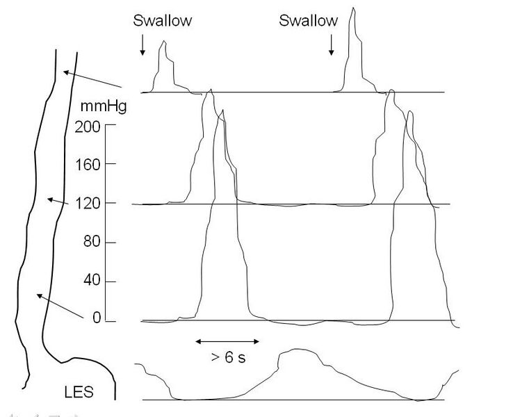 File:Nutcracker manometry.jpg