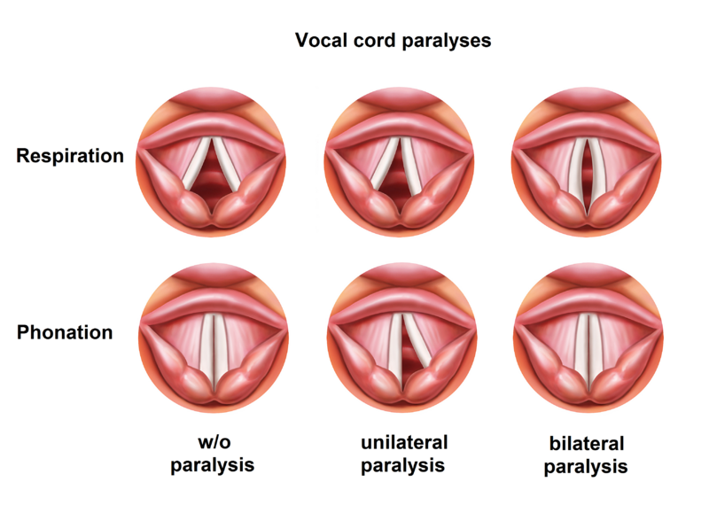 File:Vocalcordparalyses.png