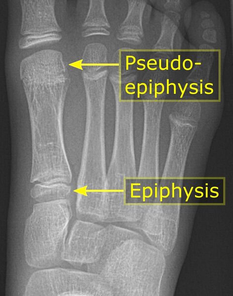 File:Metatarsal pseudo-epiphysis.jpg