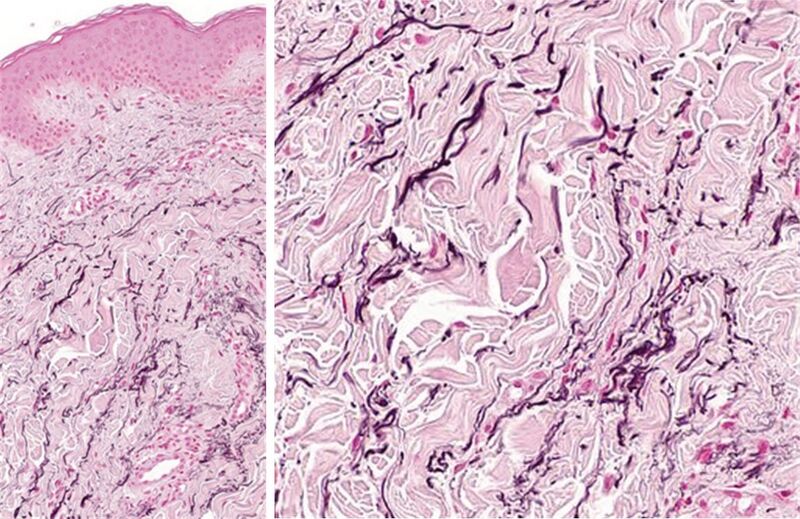 File:Histopathology of linear focal elastosis.jpg
