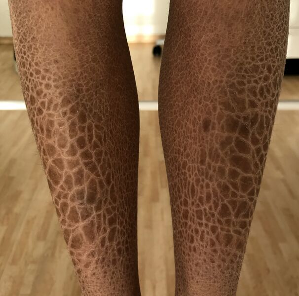 File:Ichthyosis (2).jpg