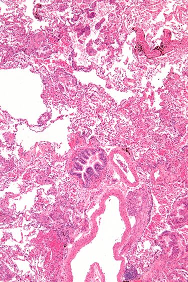 File:Lymphangioleiomyomatosis - low mag.jpg