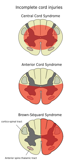 Incomplete cord injuries