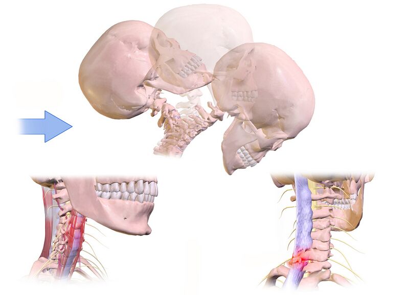 File:Whiplash Injury.jpg