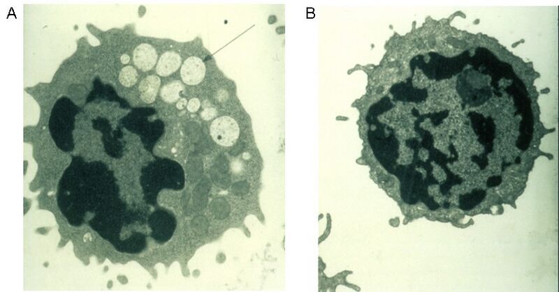 File:Alpha-mannosidosis electron micrograph.JPEG