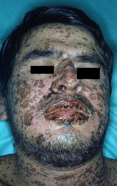 File:Stevens-johnson-syndrome.jpg