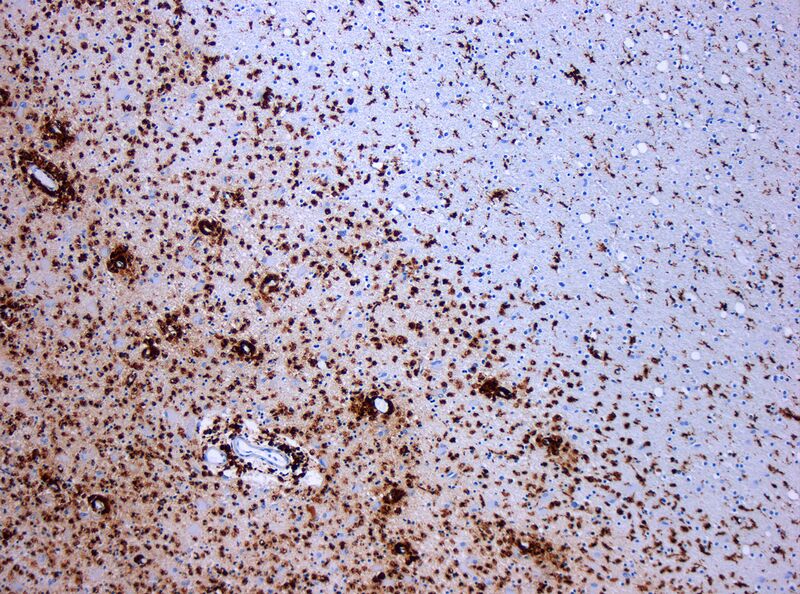 File:MS Demyelinisation CD68 10xv2.jpg