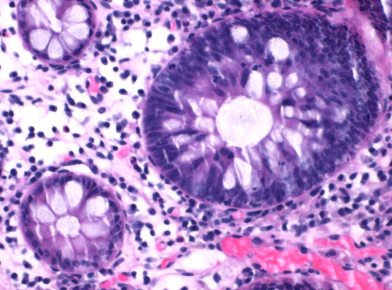 File:Non-proliferative versus proliferative colonic crypts.jpg