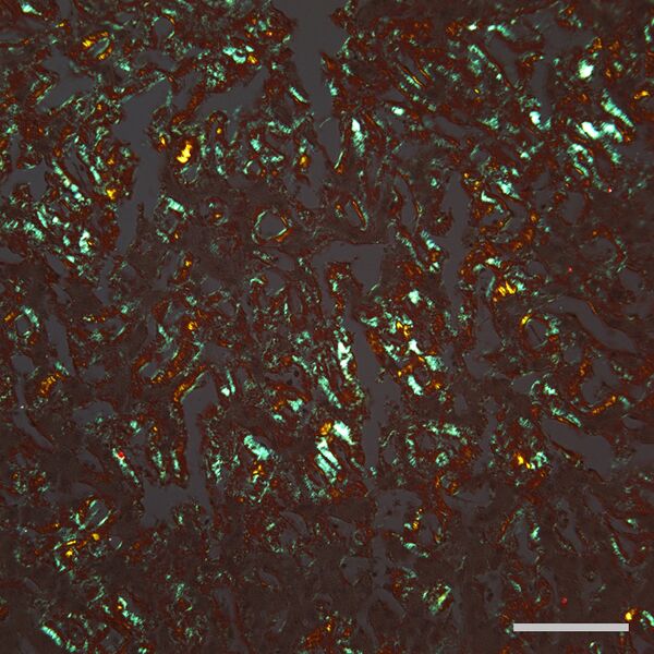File:Amyloid Liver Congo Red Bar=100um.jpg