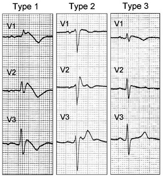 File:Brugada.jpg