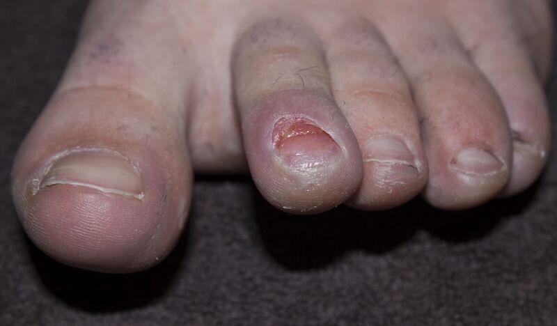 File:Runners toe.jpg