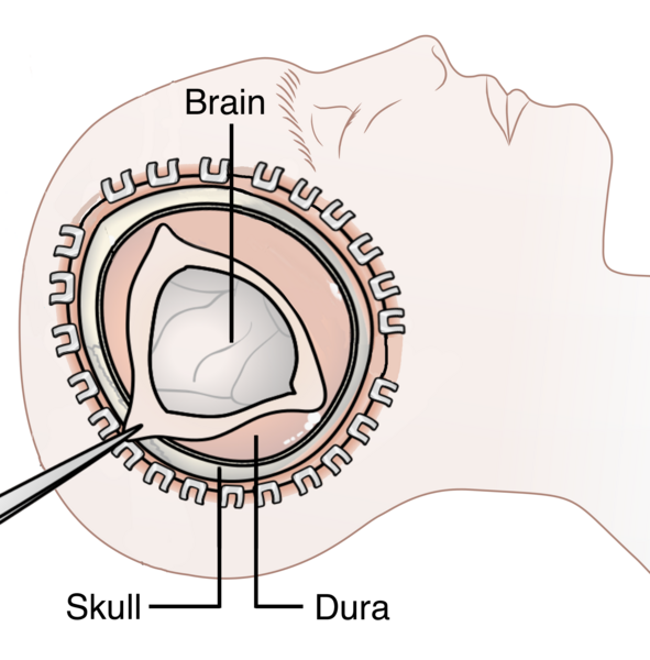 File:Decompressive Craniectomy.png