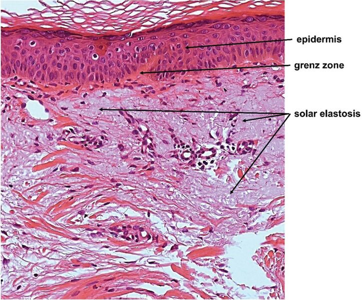 File:Micrograph of solar elastosis.jpg
