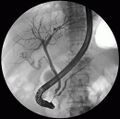 ERCP showing pancreatic duct
