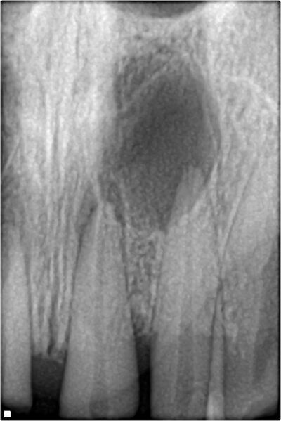 File:Periapical radiolucency.jpg