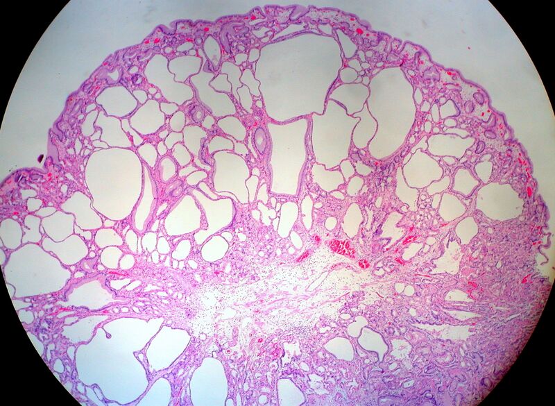 File:Fundic Gland Polyp, Stomach (3295692096).jpg