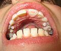 Fractured tooth