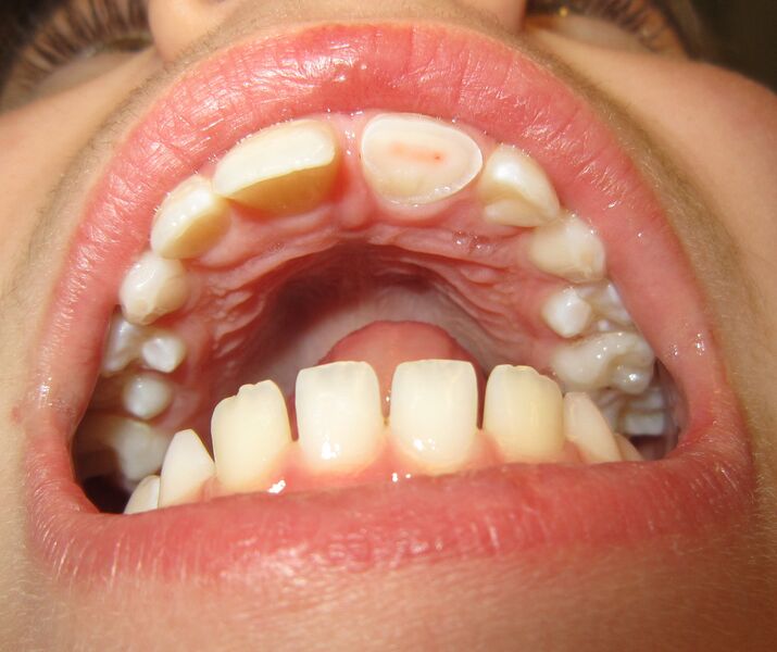File:Fracturedtooth.jpg