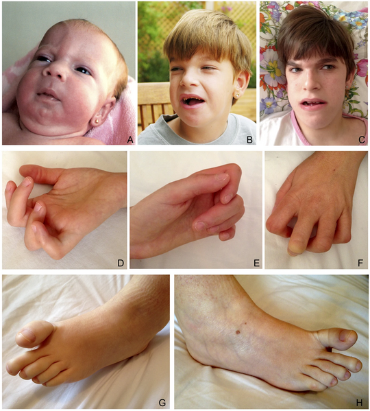 File:Person with Schaaf-Yang syndrome.webp