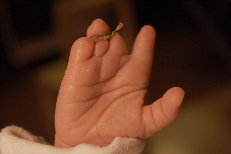 File:Amniotic band hand.jpg