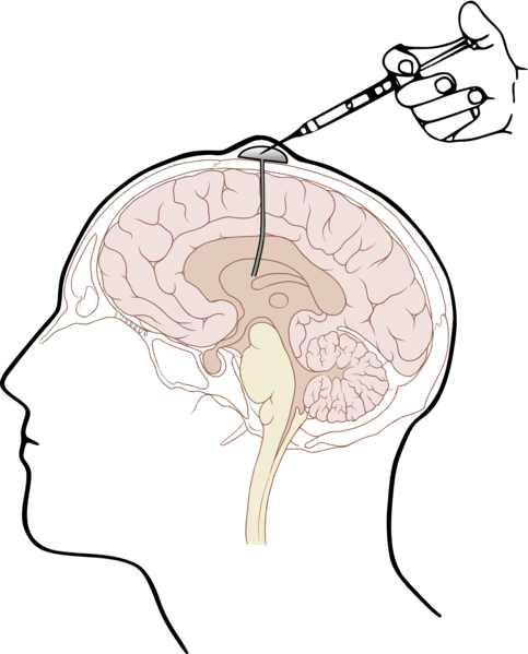 File:Ommaya 01.png