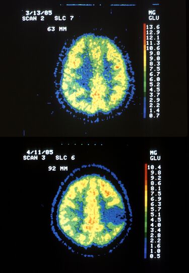 File:Astrocytoma.jpg