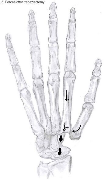 File:Forces after trapeziectomy.jpg