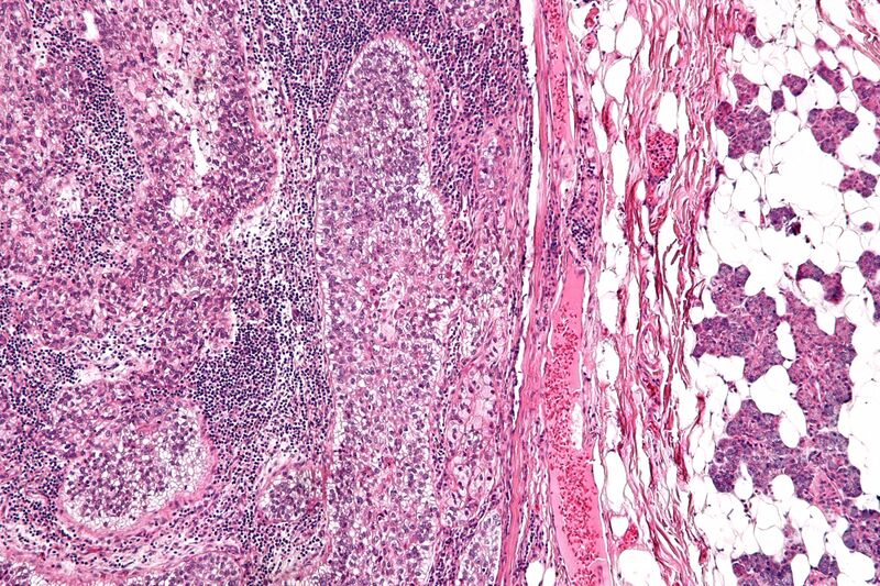 File:Sebaceous carcinoma - intermed mag.jpg