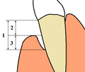 Diagram showing periodontal terms related to gingival recession