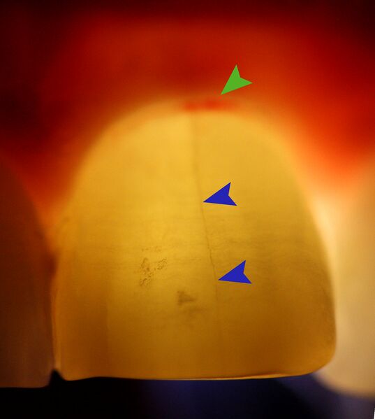 File:Transillumination of tooth marked.jpg