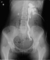 Antegrade pyelogram of grade III hydronephrosis with obstruction at the ureterovesical junction