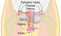 Salpingectomy