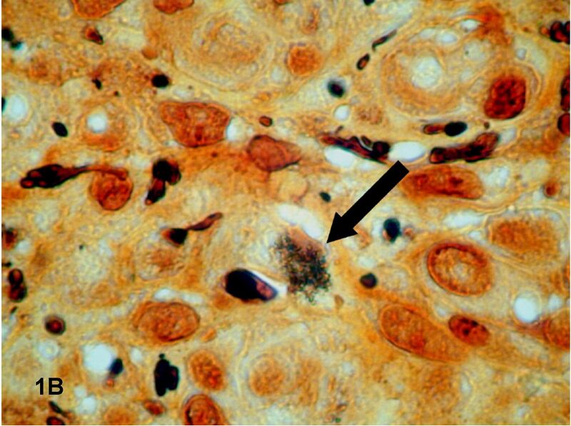 File:Bacteria on Warthin–Starry stain.jpg