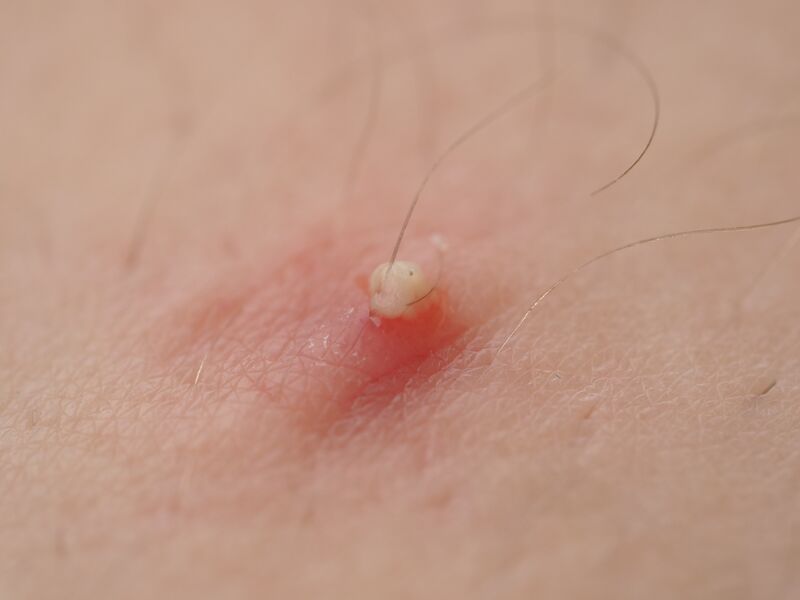 File:20200822 Pustule 2.jpg