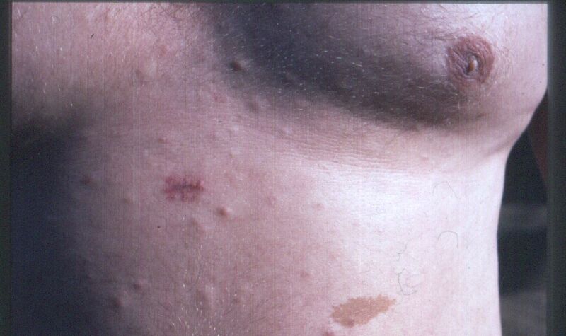File:Early neurofibromatosis.jpg