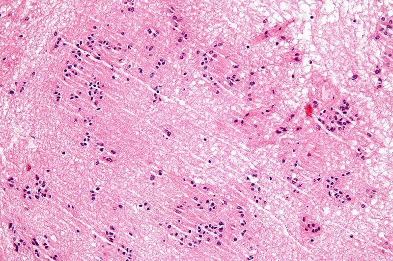 File:Subependymoma - high mag.jpg