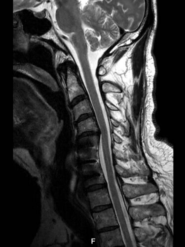 File:Cervical spine after surgery.jpg